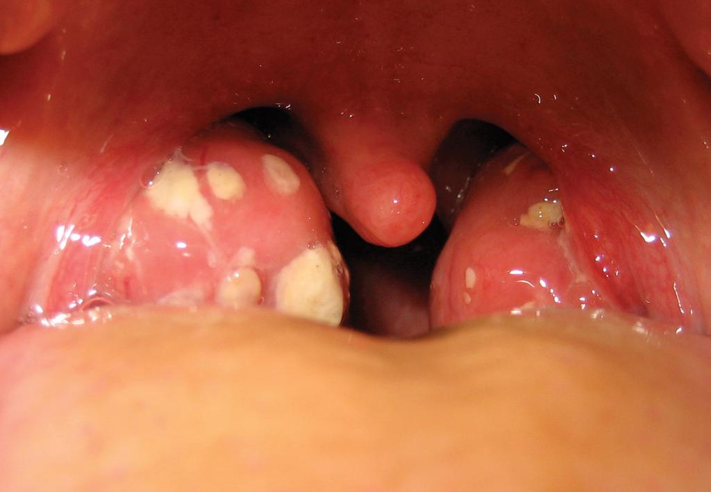 Swallowing problems Treatment in Nashik