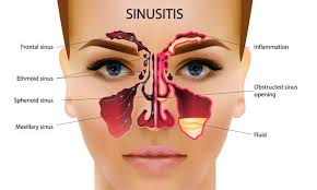 Sinus Treatment specialist In nashik