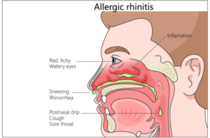 Allergic rhinitis symptoms including sneezing, runny nose, and nasal congestion