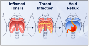 Diagram of inflamed tonsils, throat infection, and acid reflux affecting the throat.