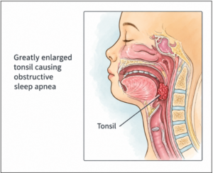 Medical illustration showing enlarged tonsils causing obstructive sleep apnea