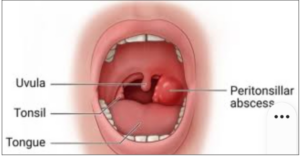 Medical illustration of a peritonsillar abscess (quinsy) causing throat swelling and pain