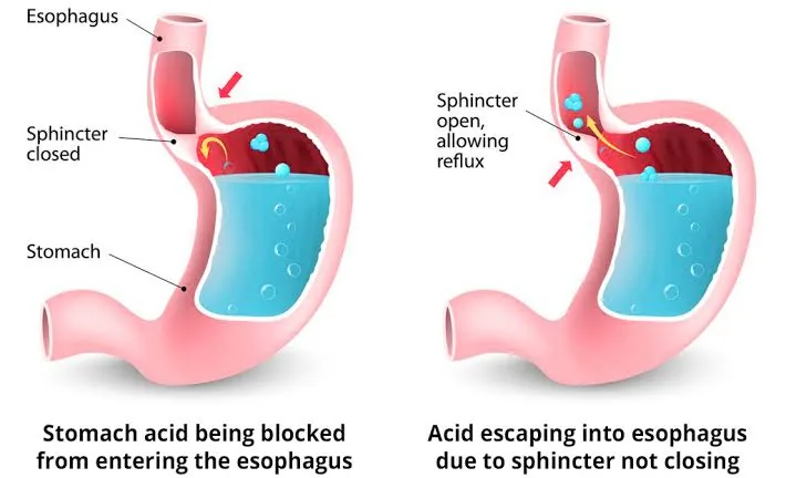 Diagram of the stomach and esophagus showing a closed sphincter, and acid escaping into the esophagus when the sphincter stays open