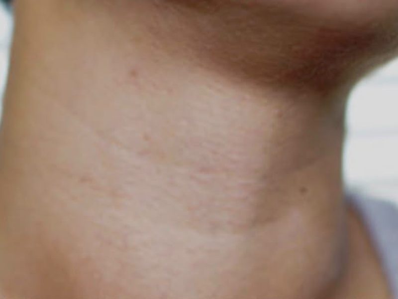 Neck swelling from a colloid goiter before surgery