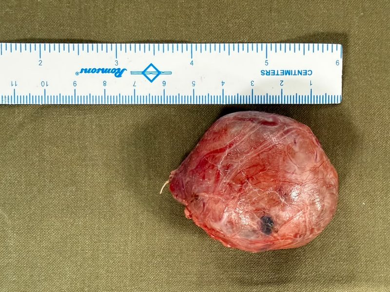 Removed colloid goiter measured side to side with a centimetre scale