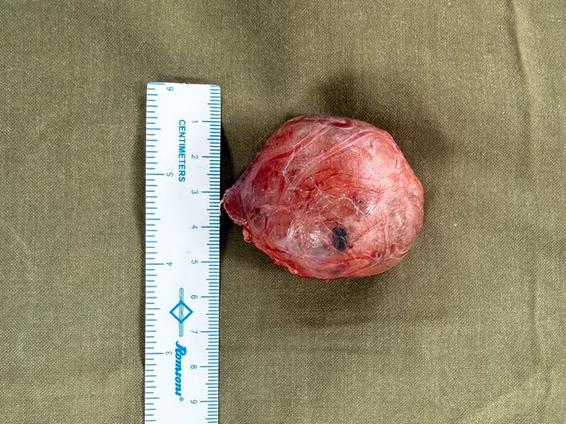 Removed colloid goiter measured top to bottom with a centimetre scale