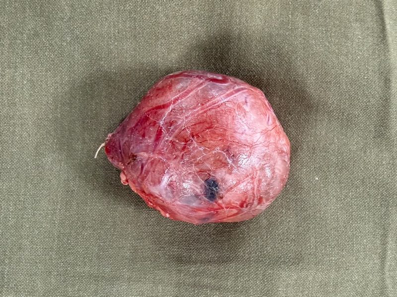 Colloid goiter after surgical removal