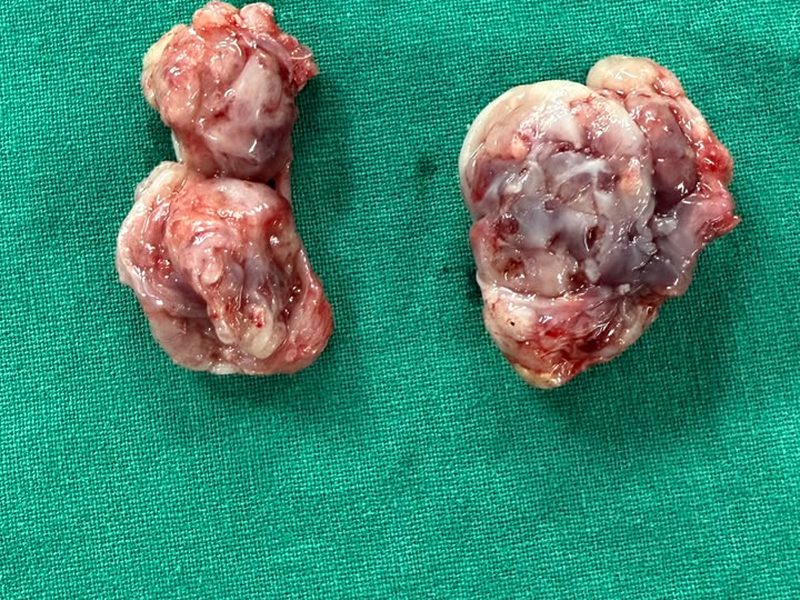 Close view of the removed enlarged tonsils