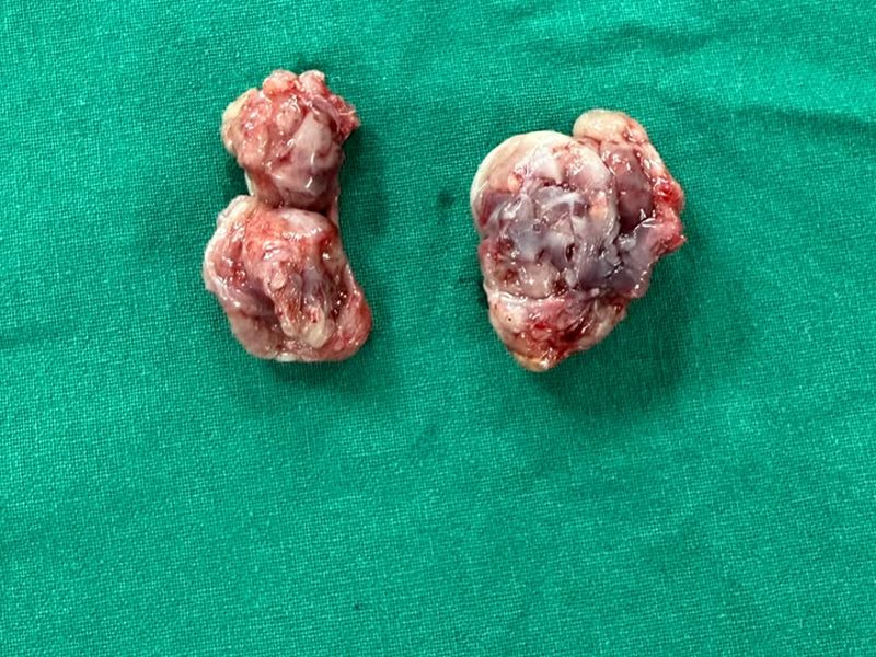 Both enlarged tonsils after removal