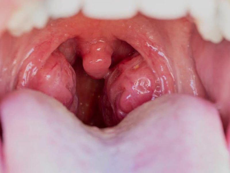 Enlarged tonsils seen in the throat